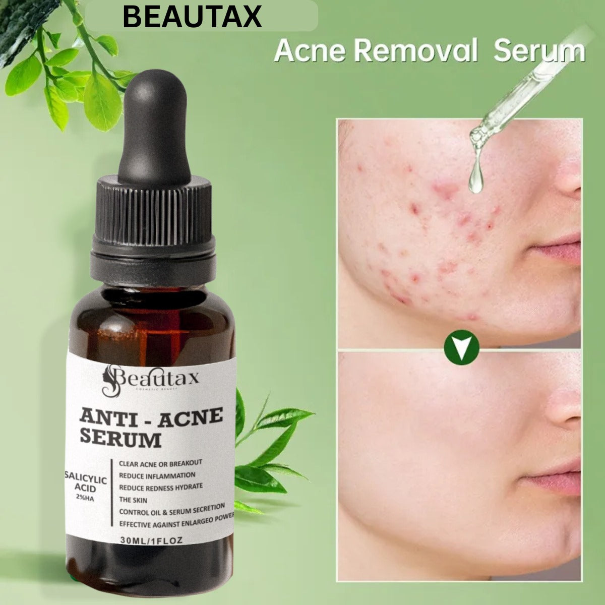 ANTI-ACNE SERUM (30ML)